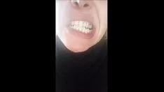 播放 前脸漂亮，但牙列很烂！